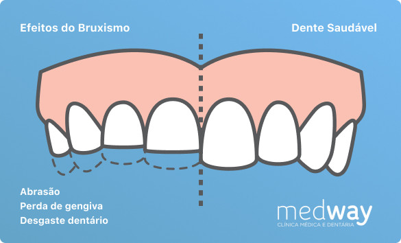 Tratamento e prevenção do Bruxismo | Clínica Medway