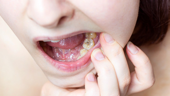 8 informações essenciais sobre Cáries Dentárias que deve mesmo conhecer
