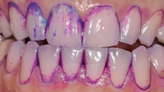 Terapia Guiada por Biofilme: conheça o método inovador de Higiene Oral