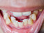 Dentes desalinhados: soluções para poder voltar a sorrir