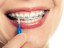 Guia passo a passo para fazer a Higiene Oral com Aparelho Dentário sem falhas
